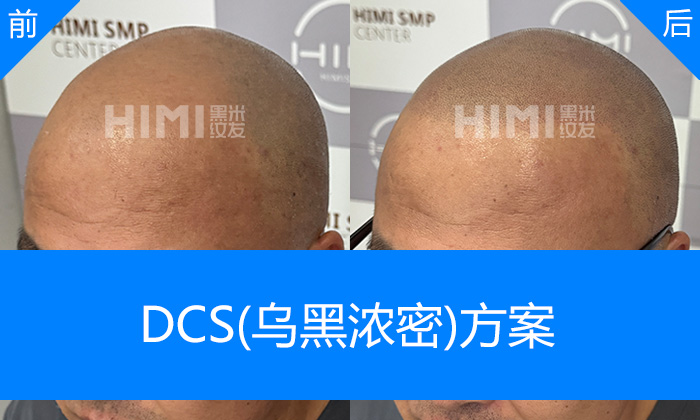 广州黑米纹发真实体验|潘先生脱发秃顶10+年重塑浓密寸头
