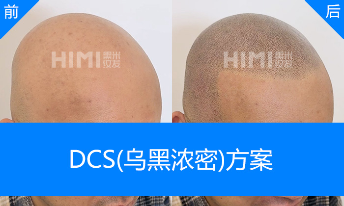 重庆黑米纹发真实体验｜李先生脱发秃顶20+年重塑浓密寸头