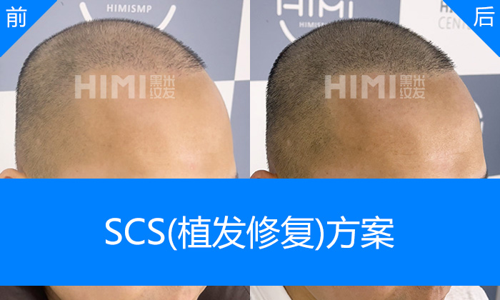杭州黑米纹发真实体验｜徐先生植发失败头顶稀疏视觉加密