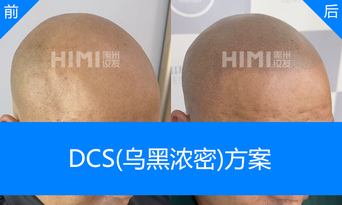 武汉黑米纹发真实体验|张先生脱发秃顶10+年重塑浓密寸头