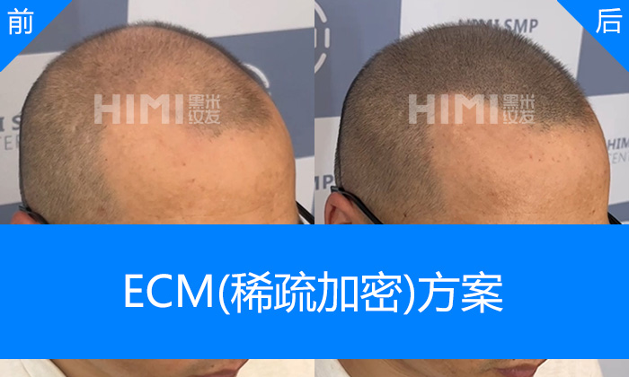 济南黑米纹发真实体验｜王先生脱发10年头顶稀疏发量加密
