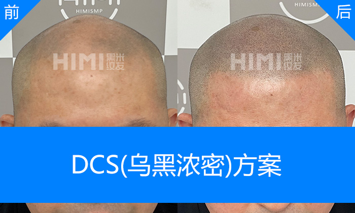 北京黑米纹发真实体验｜王先生脱发秃顶10年重塑浓密寸头
