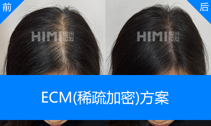 沈阳黑米纹发真实体验｜闵女士脱发3年发缝从宽变窄