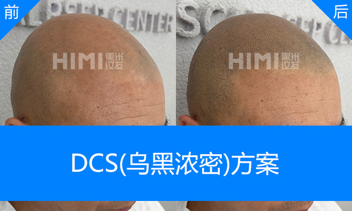 长春黑米纹发真实体验｜邱先生脱发秃顶10年重塑浓密寸头