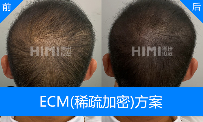 广州黑米纹发真实体验｜梁先生脱发10+年头顶稀疏发量显浓密