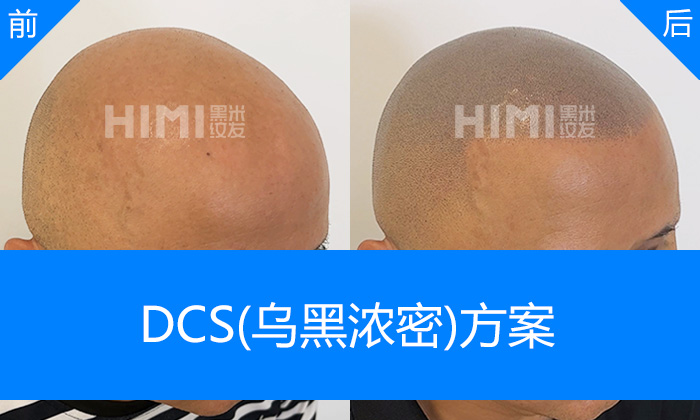 重庆黑米纹发真实体验｜杨先生脱发秃顶10多年重塑浓密寸头