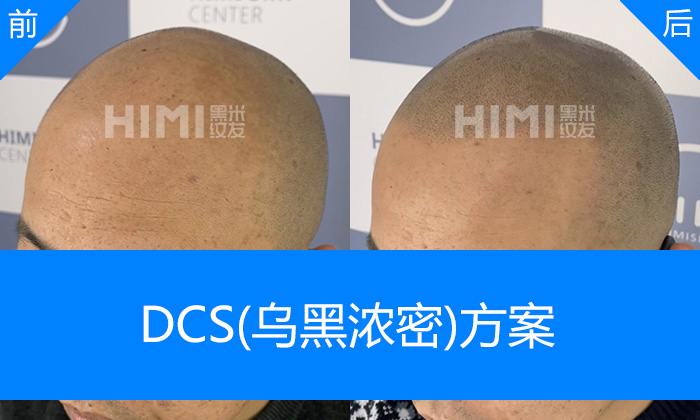 杭州黑米纹发真实体验｜胡先生脱发秃顶10多年重塑浓密寸头