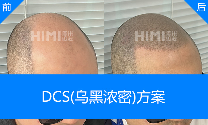 武汉黑米纹发真实体验｜庹先生脱发秃头重塑浓密寸头