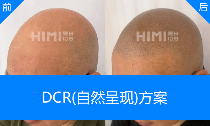 于先生脱发秃头重塑浓密寸头｜济南黑米纹发真实体验