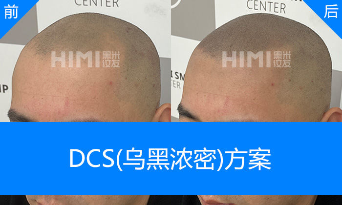 王先生头顶稀疏发际线后移｜北京黑米纹发真实体验