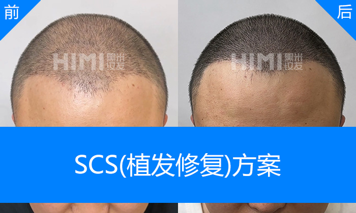 张先生植发失败头顶稀疏视觉加密|沈阳黑米纹发真实体验