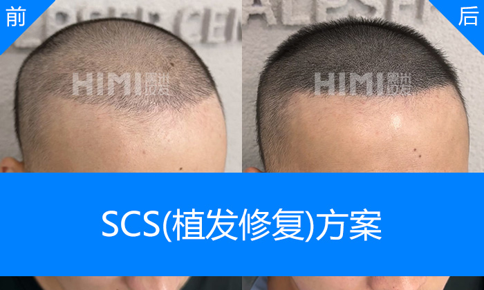 李先生植发失败头顶稀疏视觉加密｜长春黑米纹发真实体验
