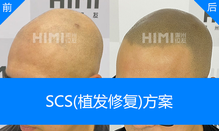 李先生从植发失败秃顶到浓密寸头｜广州黑米纹发真实体验