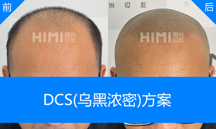 陈先生头顶严重稀疏秃顶重塑浓密寸头造型｜杭州黑米纹发真实体验
