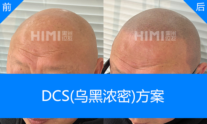 刘先生头顶几乎光秃重塑浓密寸头形象｜武汉黑米纹发真实体验