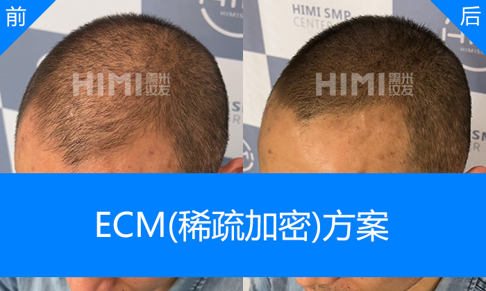 李先生头顶稀疏纹发后显浓密｜济南黑米纹发真实体验