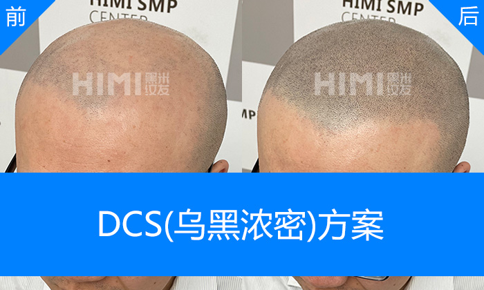王先生地中海秃顶重塑浓密寸头形象｜北京黑米纹发真实体验