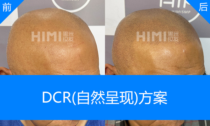 崔先生头顶光秃重塑浓密寸头|沈阳黑米纹发真实体验