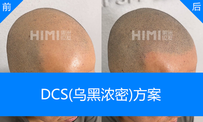 头发严重稀疏,剃短头发纹发后变帅气清爽寸头 头发严重稀疏,剃短头发纹发后变帅气清爽寸头