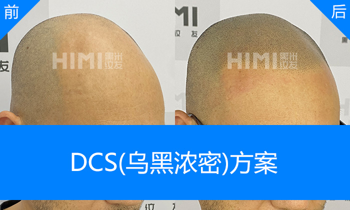 李先生脱发5年纹发后解锁清爽寸头｜广州黑米纹发真实体验