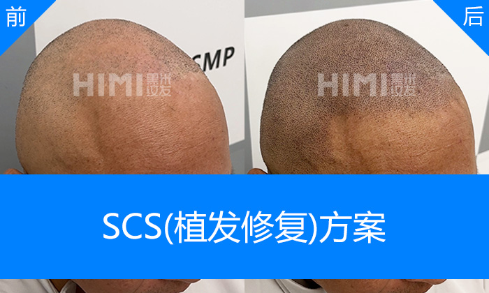 曾先生从植发失败地中海秃顶到浓密寸头｜重庆黑米纹发真实体验