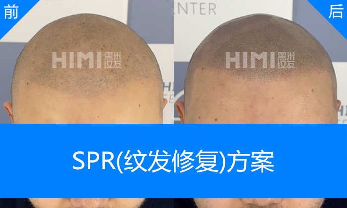 胡先生纹发失败修复重拾自信形象｜杭州黑米纹发真实体验