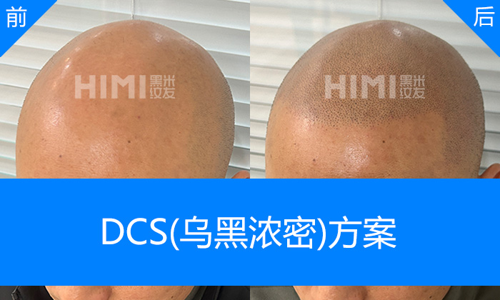 李先生脱发5+年纹发后浓密寸头｜武汉黑米纹发真实体验